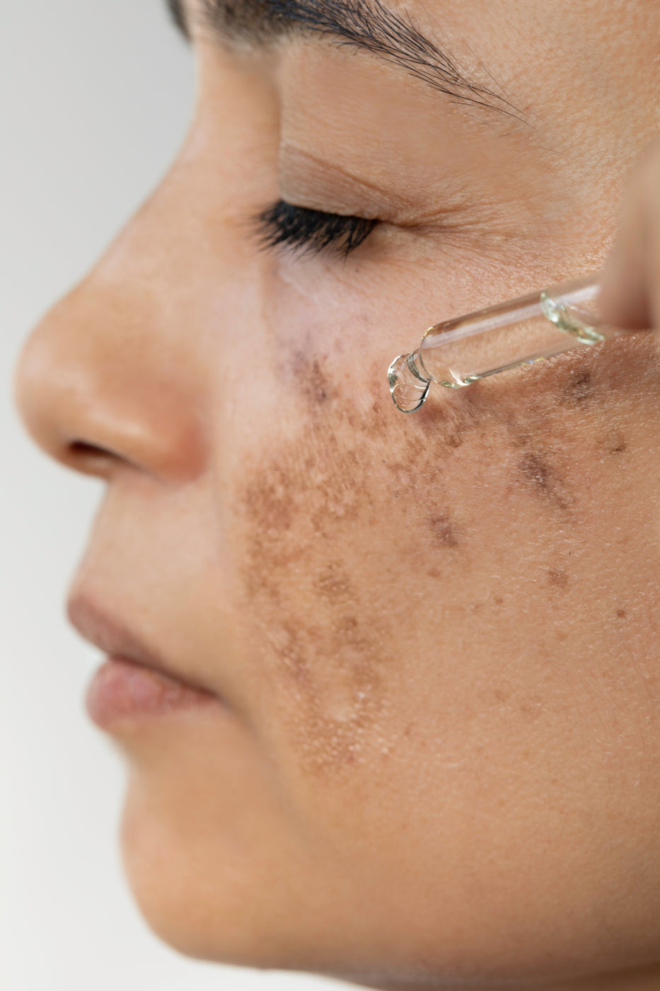 Nahaufnahme eines weiblichen Gesichts von der Seite mit rissigen Stellen auf der Wange, auf die Serum aufgetragen wird