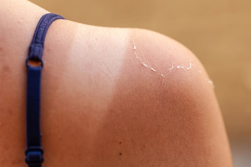 Nahaufnahme einer Schulter mit Sonnenbrand und sich lösender Haut